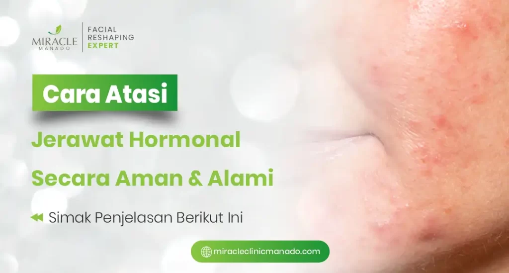 Cara Atasi Jerawat Hormonal Secara Aman dan Alami
