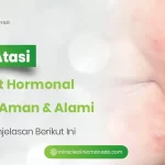 Cara Atasi Jerawat Hormonal Secara Aman dan Alami