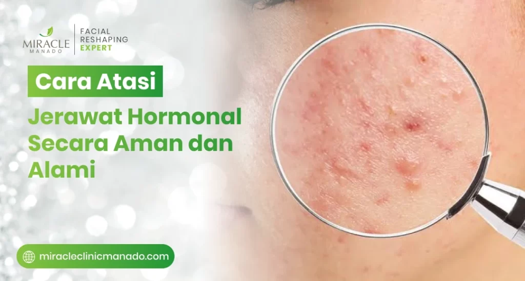 Cara Atasi Jerawat Hormonal Secara Aman dan Alami