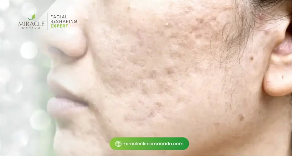 Manfaat Biocell Transdermal untuk Bekas Jerawat Membandel