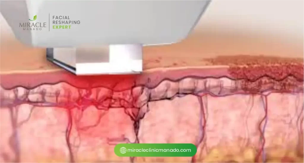 Manfaat MD Laser untuk Kulit Kusam