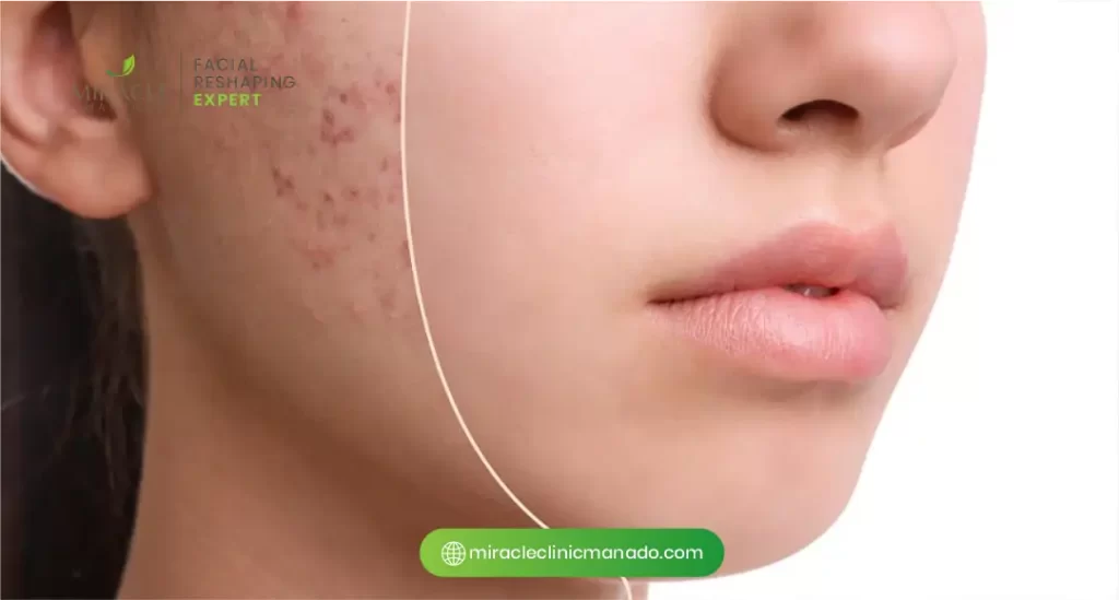 Manfaat Biocell Transdermal Therapy