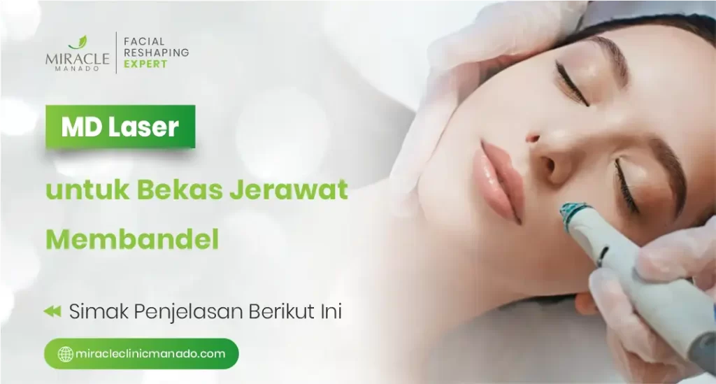 MD Laser untuk Bekas Jerawat Membandel