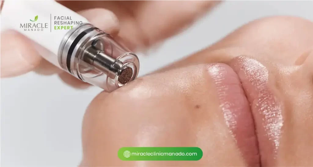 Manfaat MD Laser untuk Bekas Jerawat Membandel