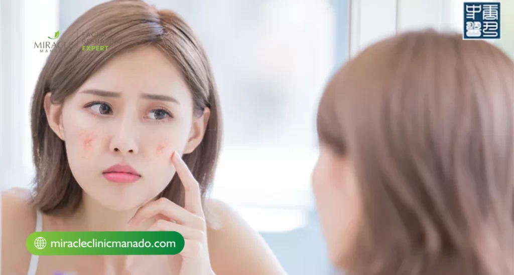 Penyebab Jerawat Meradang yang Perlu Diketahui