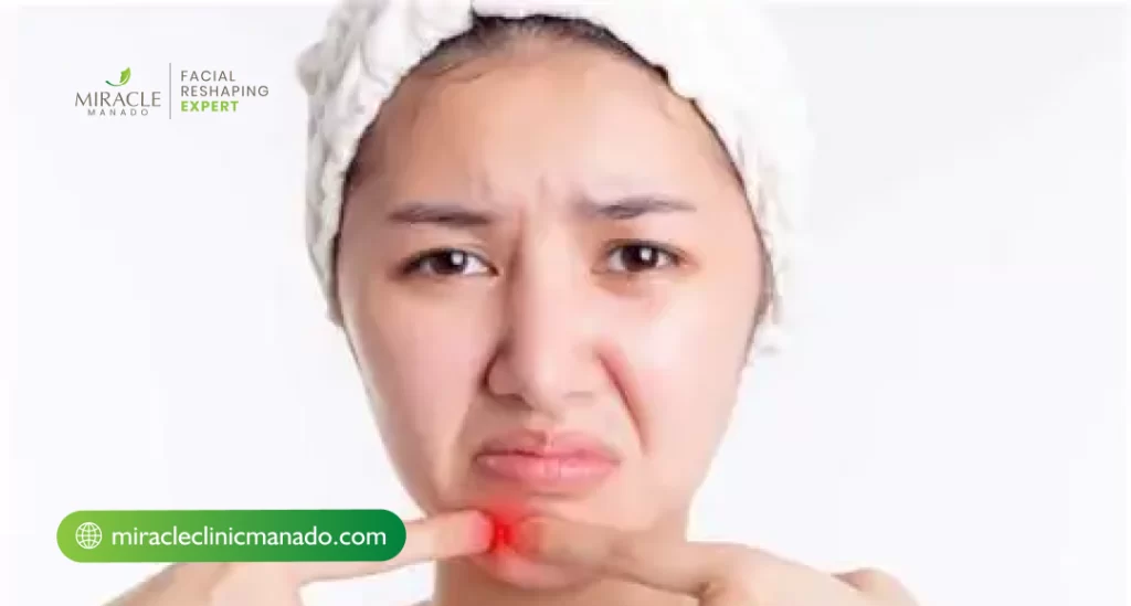 Solusi Jerawat Meradang dan Nyeri yang Aman Tanpa Efek Samping