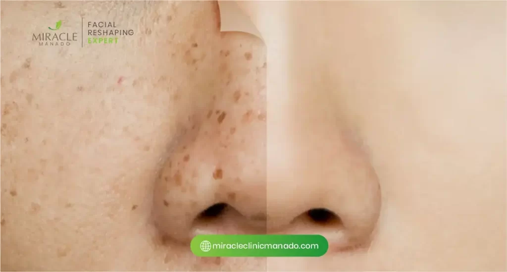 Tips Mencegah Flek Hitam di Wajah