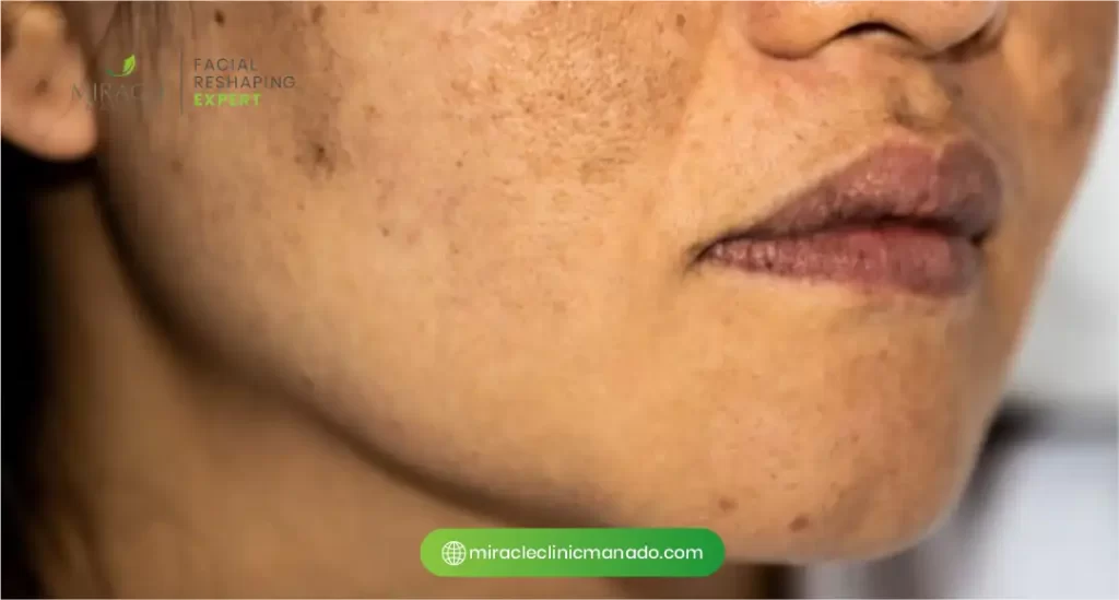 Pentingnya Mencegah Flek Hitam Sejak Dini