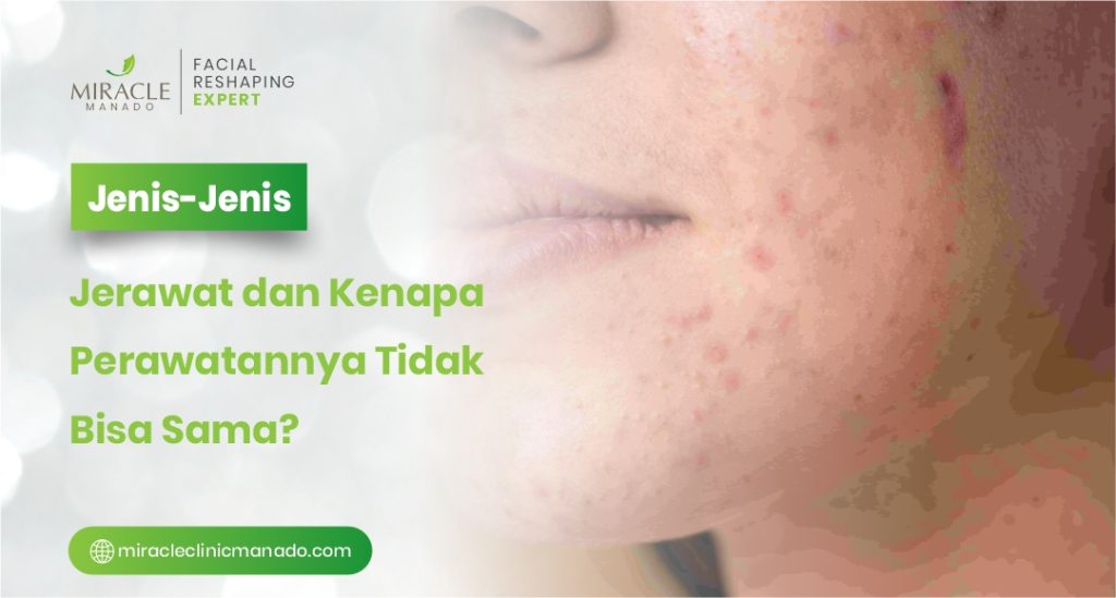 Jenis Jenis Jerawat