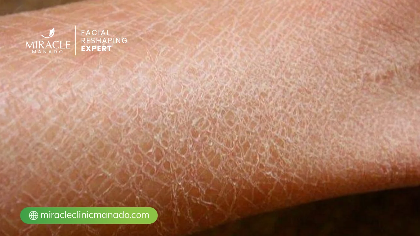 Apa Itu Kulit Kering?