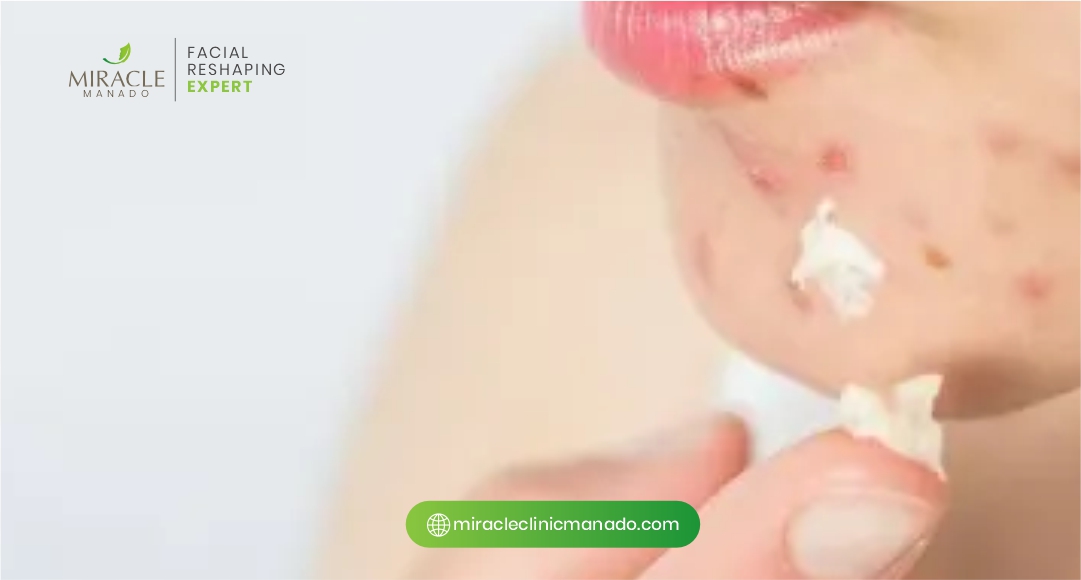 Jerawat Nodul dan Kistik