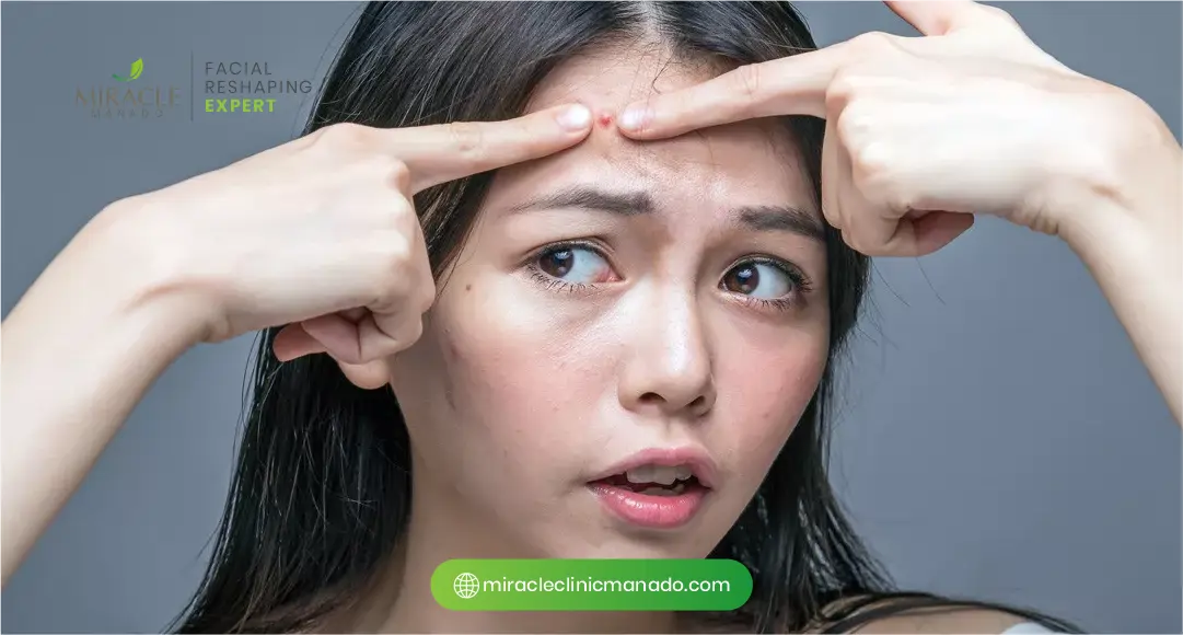 1. Tips Perawatan Wajah Pasca Jerawat Supaya Tidak Membekas