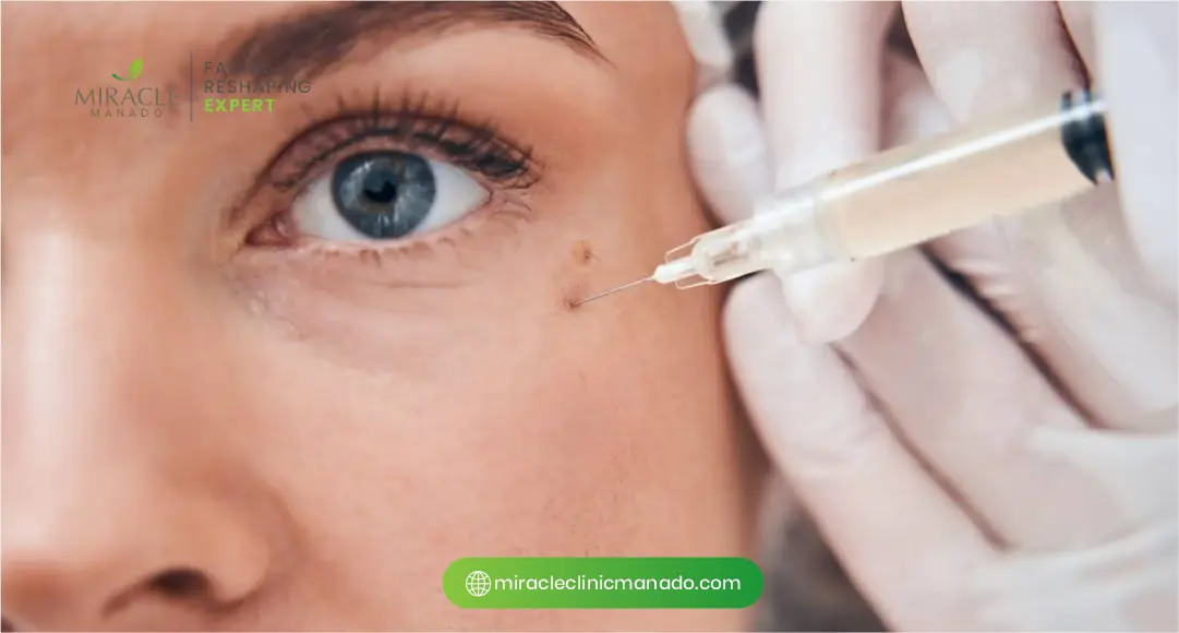 2. Ragam Jenis Filler Bawah Mata Agar Segar Penampilan Maksimal