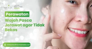 Perawatan Wajah Pasca Jerawat agar Tidak Bekas
