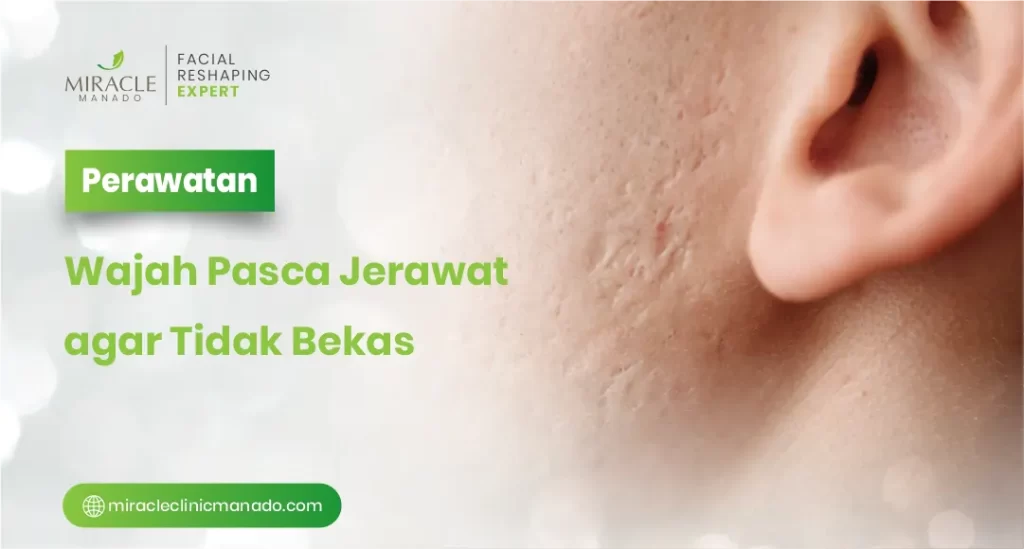 Perawatan Wajah Pasca Jerawat agar Tidak Bekas