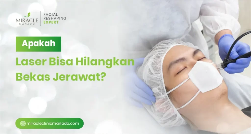 Apakah Laser Bisa Hilangkan Bekas Jerawat_