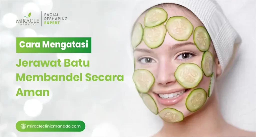 Cara Mengatasi Jerawat Batu Membandel Secara Aman