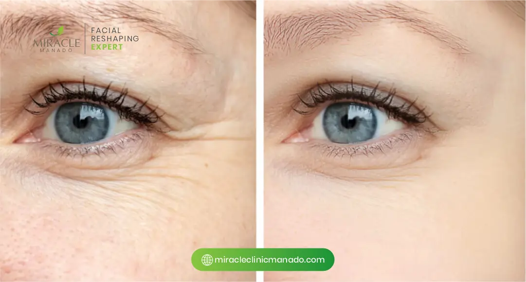 Tips Aman Sebelum dan Sesudah Perawatan Botox