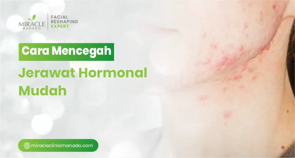Cara Mencegah Jerawat Hormonal Mudah
