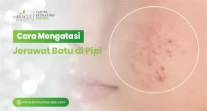 Cara Mengatasi Jerawat Batu di Pipi