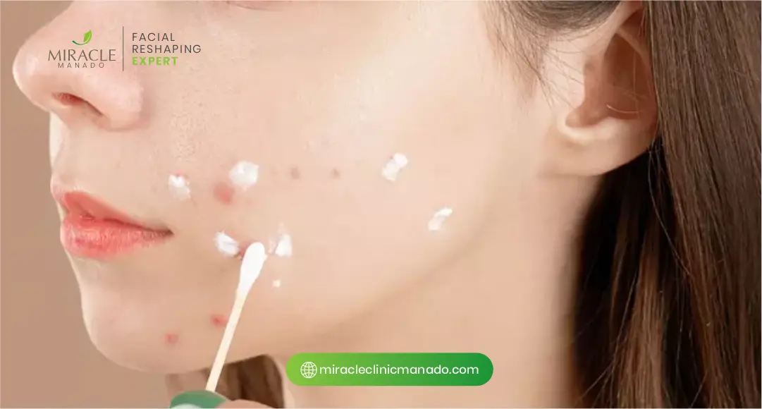 Cara Menggunakan Obat Totol Jerawat Alami