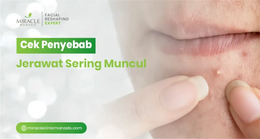 Cek Penyebab Jerawat Sering Muncul