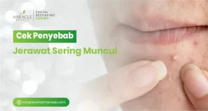 Cek Penyebab Jerawat Sering Muncul