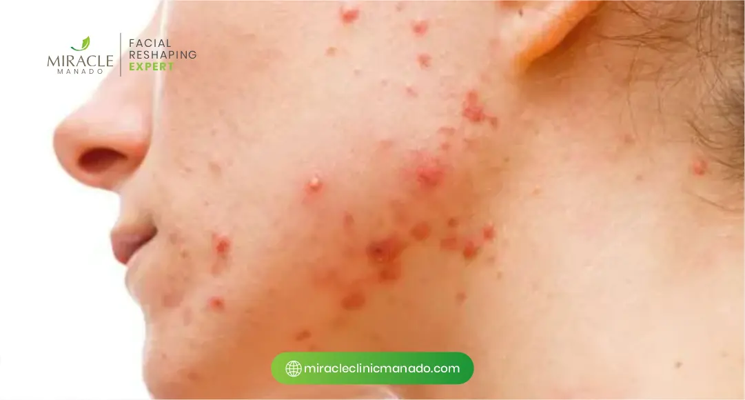 Mencegah Jerawat Hormonal dari Dalam Tubuh