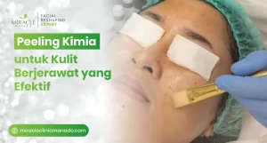 Peeling Kimia untuk Kulit Berjerawat yang Efektif