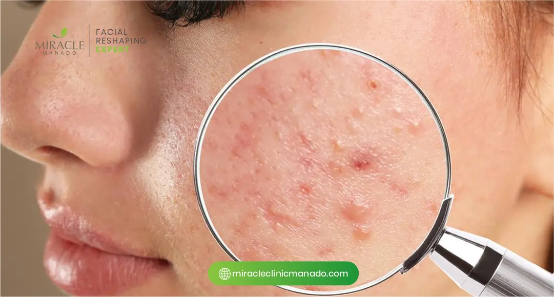 Penjelasan Medis Tentang Jerawat Hormonal