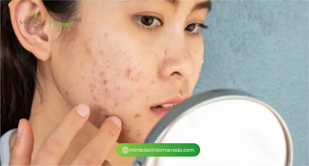 Penyebab dan Pola Kemunculan Jerawat Hormonal