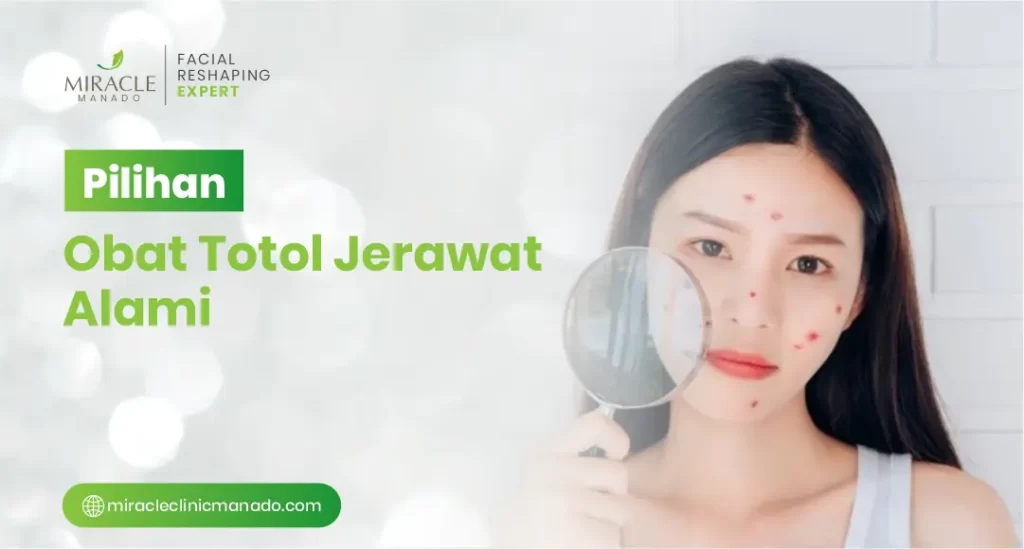 Pilihan Obat Totol Jerawat Alami