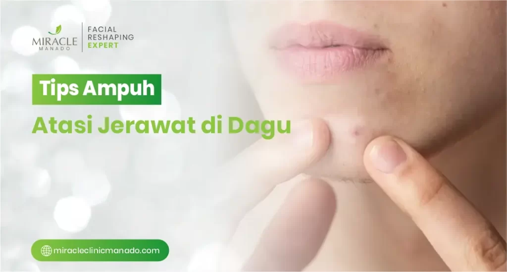 Tips Ampuh Atasi Jerawat di Dagu