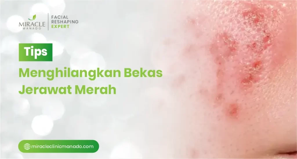 Tips Menghilangkan Bekas Jerawat Merah