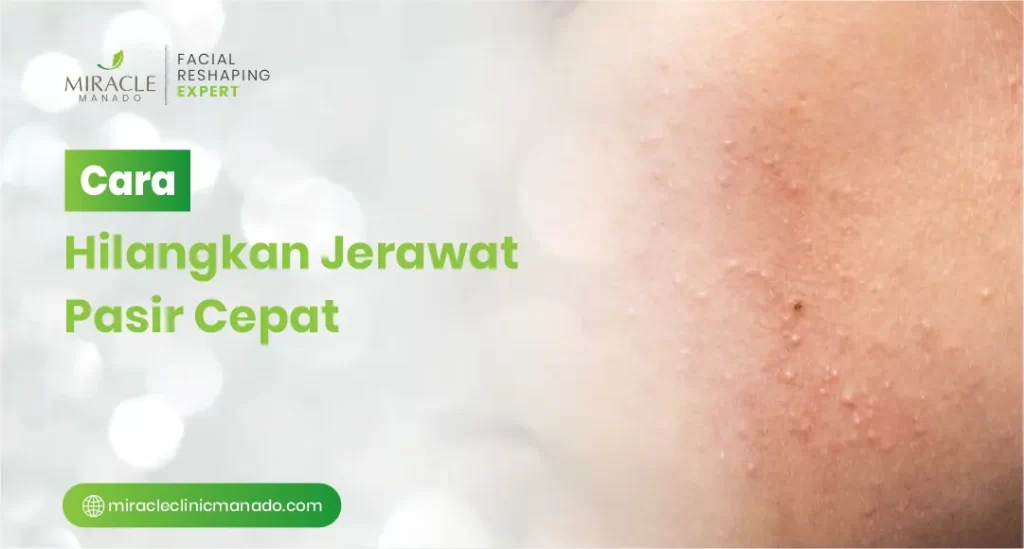 Cara Hilangkan Jerawat Pasir Cepat