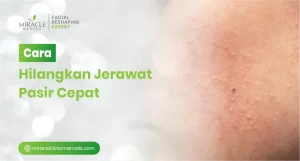 Cara Hilangkan Jerawat Pasir Cepat