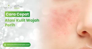 Cara Cepat Atasi Kulit Wajah Perih