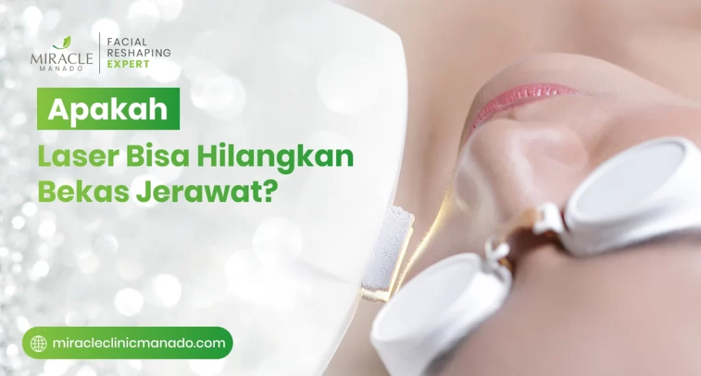 Apakah Laser Bisa Hilangkan Bekas Jerawat
