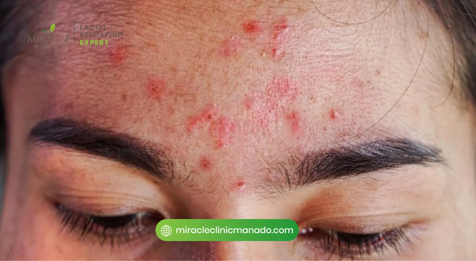 Beberapa Efek Samping Botox Wajah Perlu Diketahui